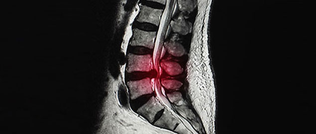 herniated disc chiropractor in Campbell, CA