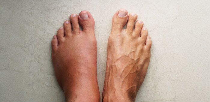 patient needing complex regional pain syndrome treatment in Campbell