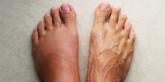 complex regional pain syndrome Treatment in Campbell
