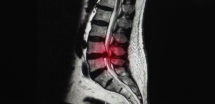 patient needing herniated disc treatment in Campbell