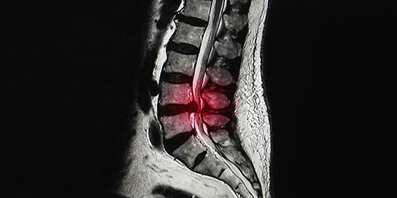 disc injury Treatment in Campbell