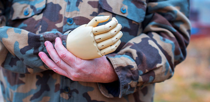 patient needing phantom limb syndrome treatment in Campbell