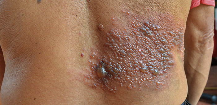 patient needing post herpetic neuralgia treatment in Campbell
