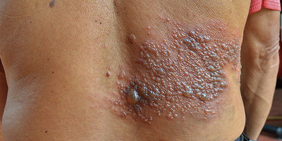 post herpetic neuralgia Treatment in Campbell