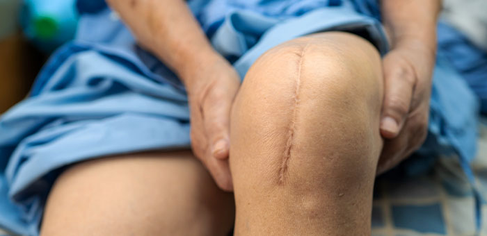 patient needing post surgical neuropathic pain treatment in Campbell