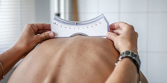 scoliosis Treatment in Campbell